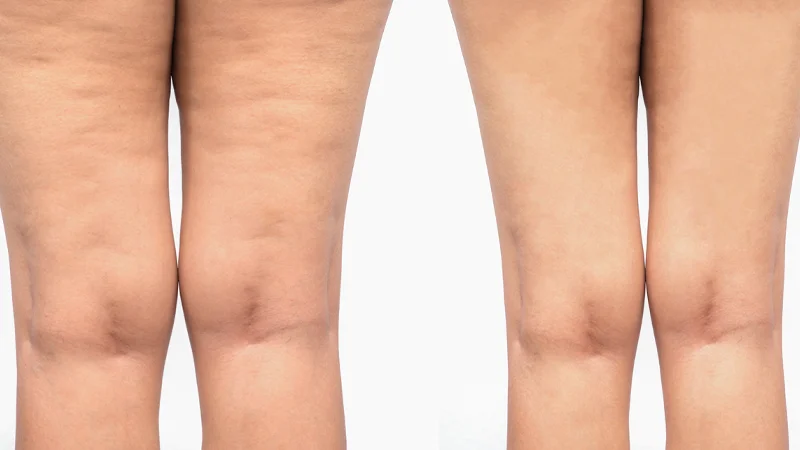 Cellulite Treatments at The Éterne Clinic